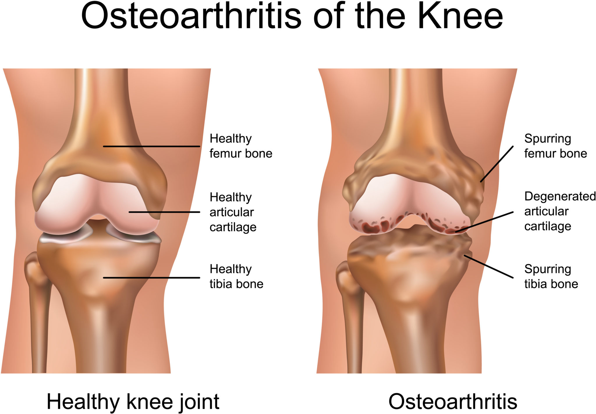 Mengenal Operasi Lutut Osteoarthritis Untuk Sendi Lutut