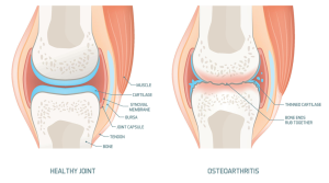 Apakah Penderita Osteoarthritis Boleh Dipijat?
