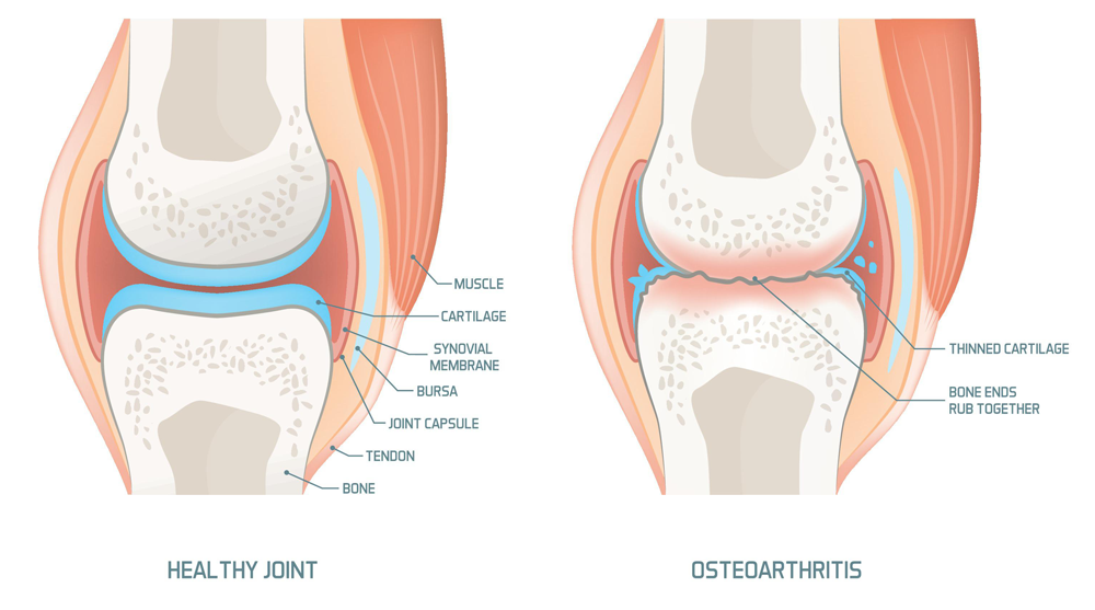 Apa yang Terjadi Jika Osteoarthritis Dibiarkan? Ini Jawabannya