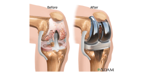Terapi Penggantian Sendi Lutut 1