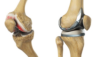 Terapi Penggantian Sendi Lutut 2