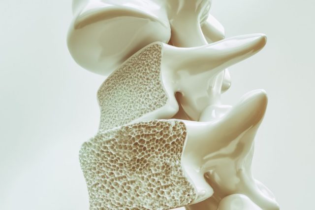 Apakah osteoporosis harus operasi