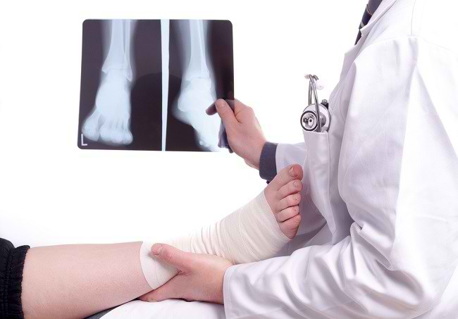 Apakah Patah Tulang Kaki Boleh Dipijat?
